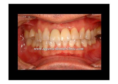 早期埋入の術前術後イメージ例7（田川歯科）